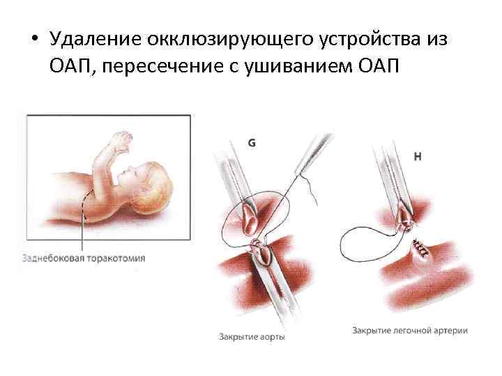  • Удаление окклюзирующего устройства из ОАП, пересечение с ушиванием ОАП 