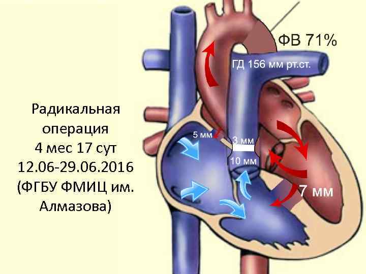 Радикальная операция 4 мес 17 сут 12. 06 -29. 06. 2016 (ФГБУ ФМИЦ им.
