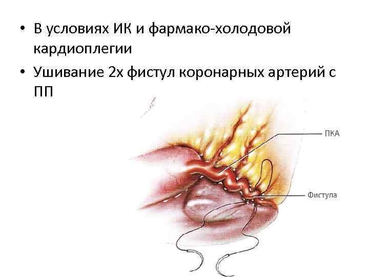  • В условиях ИК и фармако-холодовой кардиоплегии • Ушивание 2 х фистул коронарных