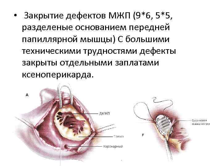  • Закрытие дефектов МЖП (9*6, 5*5, разделеные основанием передней папиллярной мышцы) С большими
