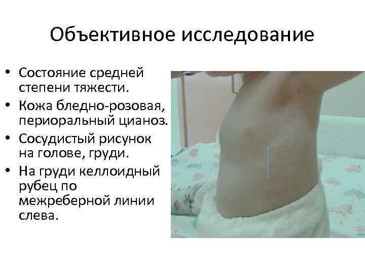 Объективное исследование • Состояние средней степени тяжести. • Кожа бледно-розовая, периоральный цианоз. • Сосудистый