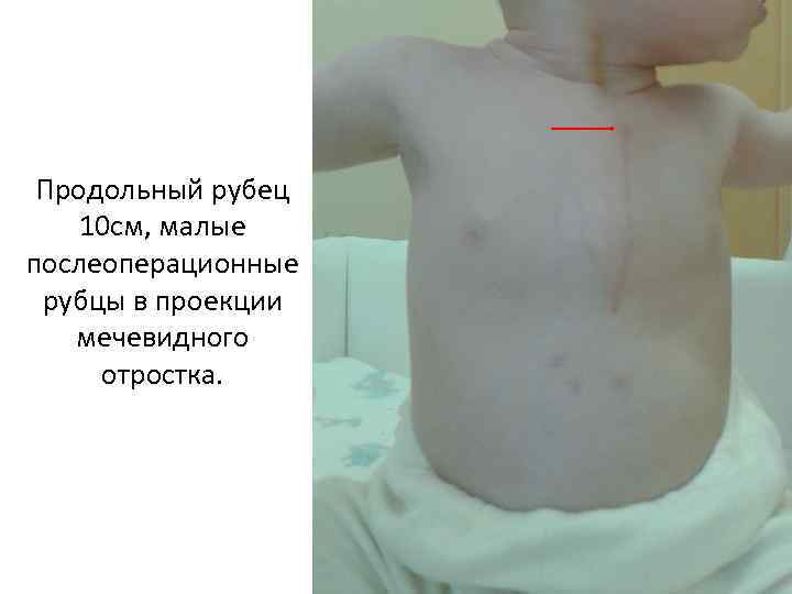 Продольный рубец 10 см, малые послеоперационные рубцы в проекции мечевидного отростка. 