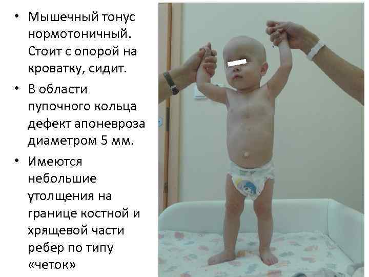  • Мышечный тонус нормотоничный. Стоит с опорой на кроватку, сидит. • В области