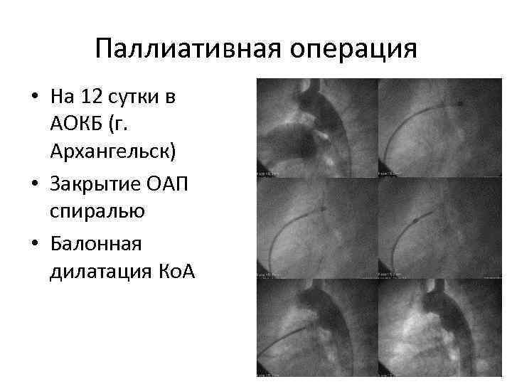 Паллиативная операция • На 12 сутки в АОКБ (г. Архангельск) • Закрытие ОАП спиралью