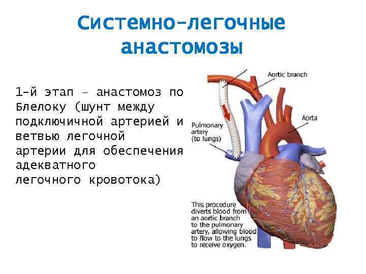 Системно-легочные анастомозы 1 -й этап – анастомоз по Блелоку (шунт между подключичной артерией и