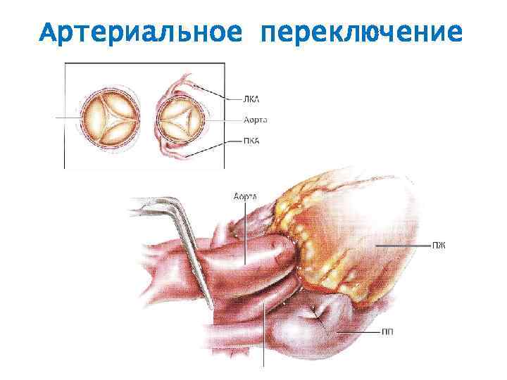 Артериальное переключение 