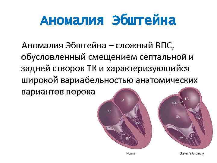 Аномалия Эбштейна – сложный ВПС, обусловленный смещением септальной и задней створок ТК и характеризующийся