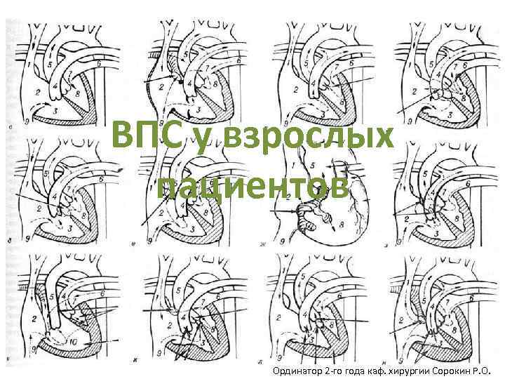 ВПС у взрослых пациентов Ординатор 2 -го года каф. хирургии Сорокин Р. О. 