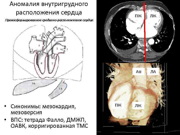 Аномалия внутригрудного расположения сердца ПЖ Ао Правосформированное срединно-расположенное сердце • Синонимы: мезокардия, мезоверсия •