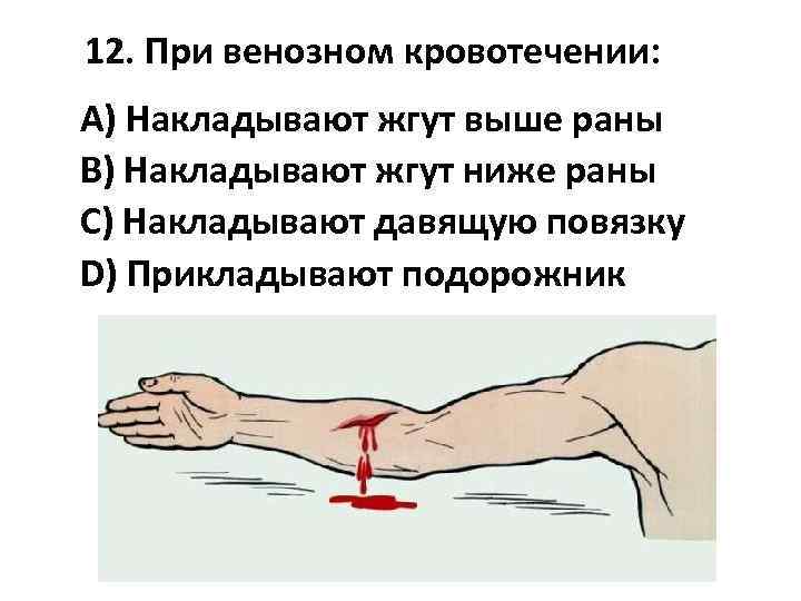 12. При венозном кровотечении: A) Накладывают жгут выше раны B) Накладывают жгут ниже раны