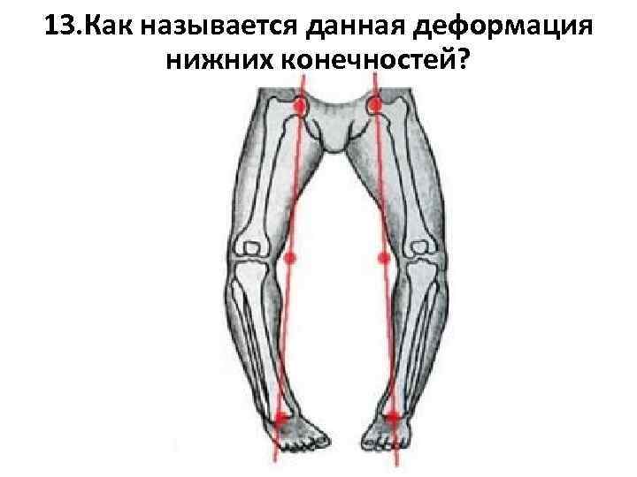13. Как называется данная деформация нижних конечностей? 