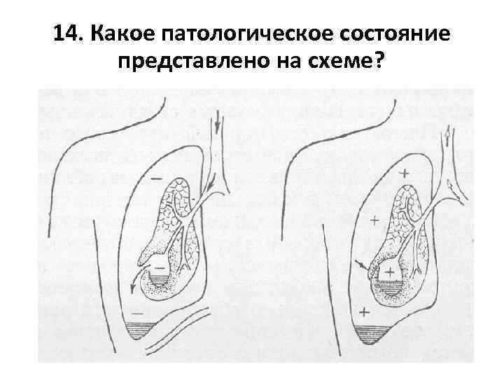 14. Какое патологическое состояние представлено на схеме? 