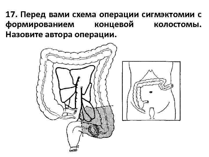 17. Перед вами схема операции сигмэктомии с формированием концевой колостомы. Назовите автора операции. 