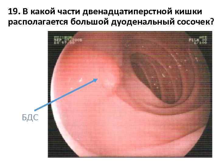 19. В какой части двенадцатиперстной кишки располагается большой дуоденальный сосочек? БДС 