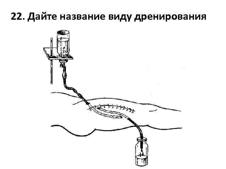 22. Дайте название виду дренирования 