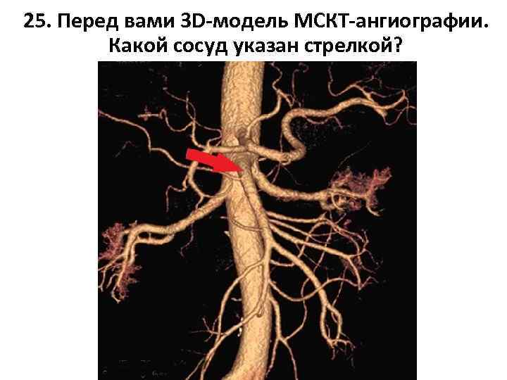 25. Перед вами 3 D-модель МСКТ-ангиографии. Какой сосуд указан стрелкой? 