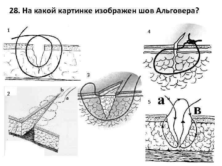 28. На какой картинке изображен шов Альговера? 1 4 3 2 5 