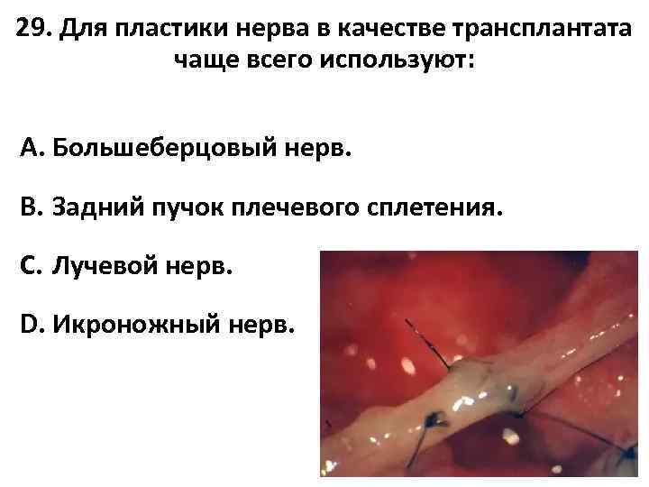 29. Для пластики нерва в качестве трансплантата чаще всего используют: A. Большеберцовый нерв. B.