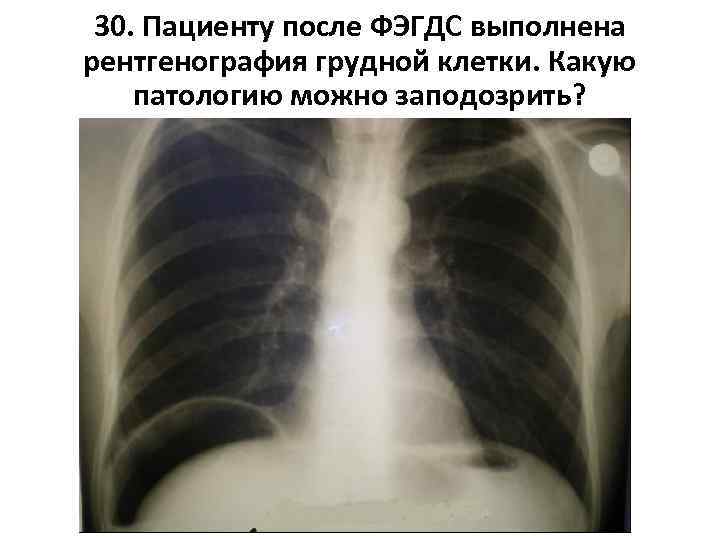 30. Пациенту после ФЭГДС выполнена рентгенография грудной клетки. Какую патологию можно заподозрить? 
