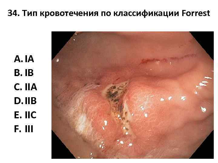 34. Тип кровотечения по классификации Forrest A. IA B. IB C. IIA D. IIB