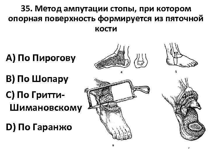 35. Метод ампутации стопы, при котором опорная поверхность формируется из пяточной кости A) По