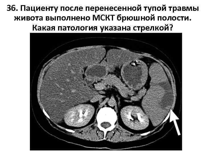 36. Пациенту после перенесенной тупой травмы живота выполнено МСКТ брюшной полости. Какая патология указана