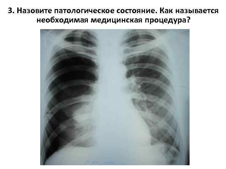 3. Назовите патологическое состояние. Как называется необходимая медицинская процедура? 