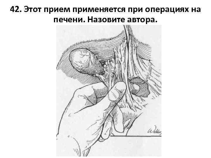 42. Этот прием применяется при операциях на печени. Назовите автора. 