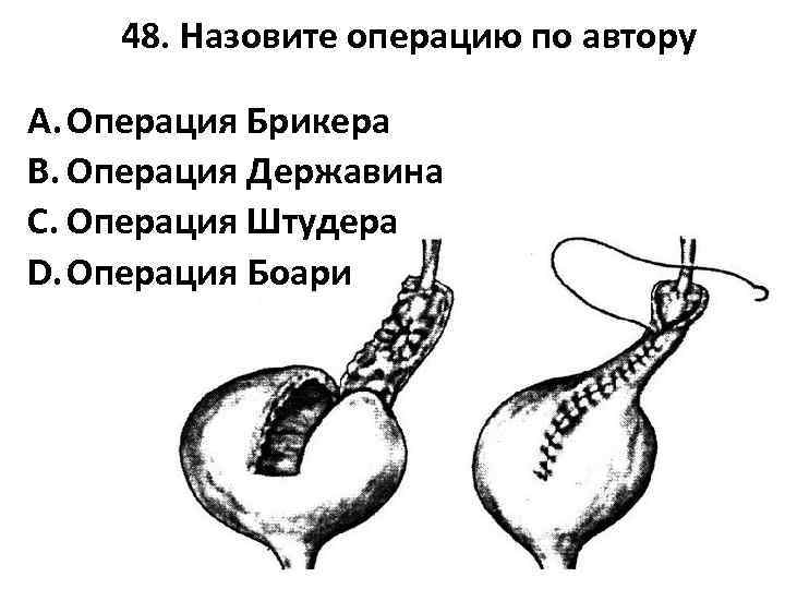 48. Назовите операцию по автору A. Операция Брикера B. Операция Державина C. Операция Штудера