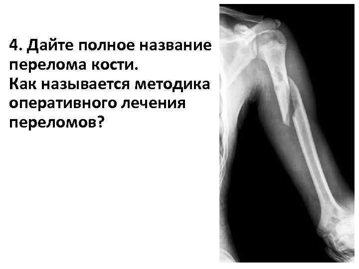 4. Дайте полное название перелома кости. Как называется методика оперативного лечения переломов? 