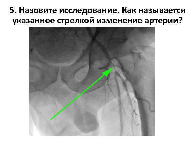 5. Назовите исследование. Как называется указанное стрелкой изменение артерии? 