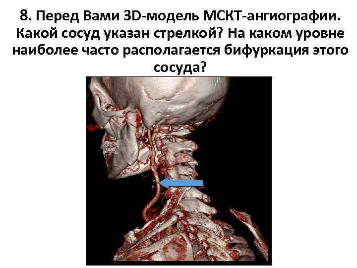 8. Перед Вами 3 D-модель МСКТ-ангиографии. Какой сосуд указан стрелкой? На каком уровне наиболее