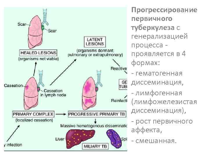 Прогрессирование первичного туберкулеза с генерализацией процесса проявляется в 4 формах: - гематогенная диссеминация, -