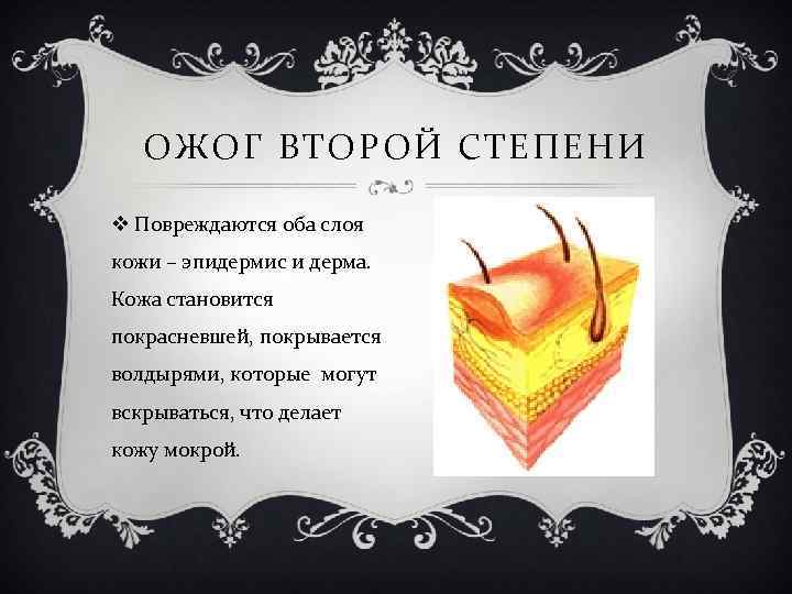 ОЖОГ ВТОРОЙ СТЕПЕНИ v Повреждаются оба слоя кожи – эпидермис и дерма. Кожа становится
