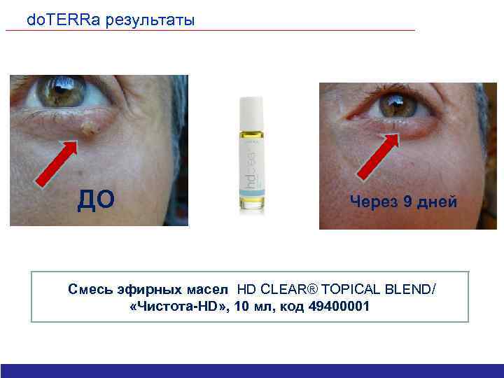 do. TERRa результаты ДО Через 9 дней Смесь эфирных масел HD CLEAR® TOPICAL BLEND/