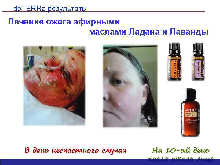 do. TERRa результаты Лечение ожога эфирными маслами Ладана и Лаванды В день несчастного случая