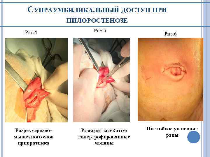 СУПРАУМБИЛИКАЛЬНЫЙ ДОСТУП ПРИ ПИЛОРОСТЕНОЗЕ Рис. 4 Рис. 5 Разрез серозно. Разводят маскитом мышечного слоя