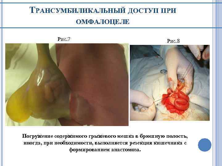 ТРАНСУМБИЛИКАЛЬНЫЙ ДОСТУП ПРИ ОМФАЛОЦЕЛЕ Рис. 7 Рис. 8 Погружение содержимого грыжевого мешка в брюшную