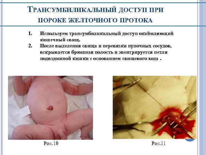 ТРАНСУМБИЛИКАЛЬНЫЙ ДОСТУП ПРИ ПОРОКЕ ЖЕЛТОЧНОГО ПРОТОКА 1. 2. Используем трансумбиликальный доступ окаймляющий кишечный свищ.
