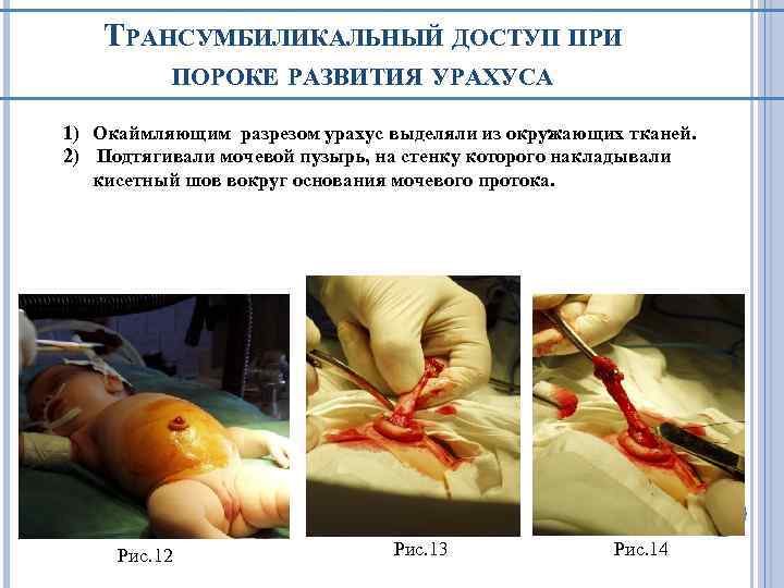 ТРАНСУМБИЛИКАЛЬНЫЙ ДОСТУП ПРИ ПОРОКЕ РАЗВИТИЯ УРАХУСА 1) Окаймляющим разрезом урахус выделяли из окружающих тканей.