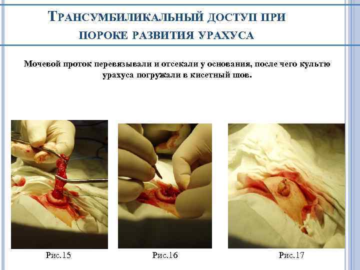 ТРАНСУМБИЛИКАЛЬНЫЙ ДОСТУП ПРИ ПОРОКЕ РАЗВИТИЯ УРАХУСА Мочевой проток перевязывали и отсекали у основания, после