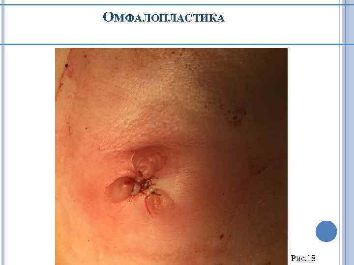 ОМФАЛОПЛАСТИКА Рис. 18 