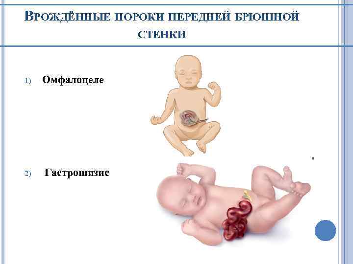 ВРОЖДЁННЫЕ ПОРОКИ ПЕРЕДНЕЙ БРЮШНОЙ СТЕНКИ 1) 2) Омфалоцеле Гастрошизис 
