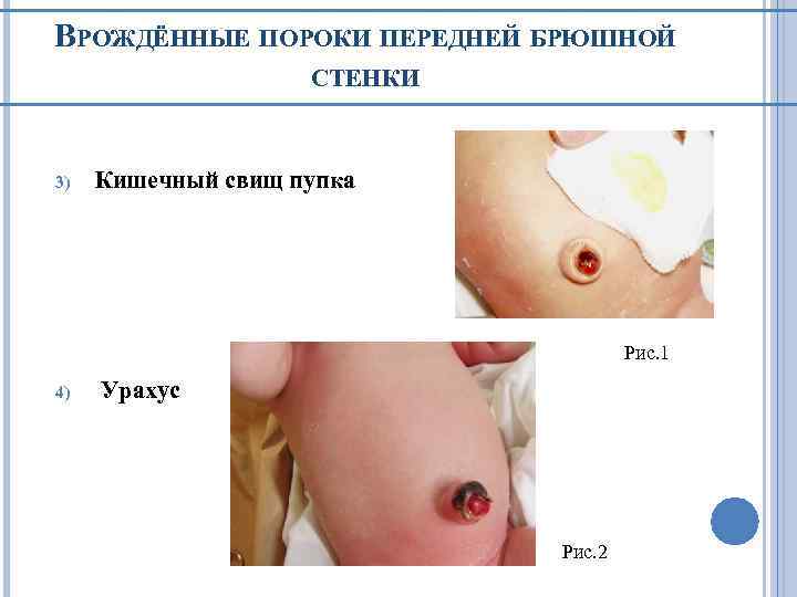 ВРОЖДЁННЫЕ ПОРОКИ ПЕРЕДНЕЙ БРЮШНОЙ СТЕНКИ 3) Кишечный свищ пупка Рис. 1 4) Урахус Рис.