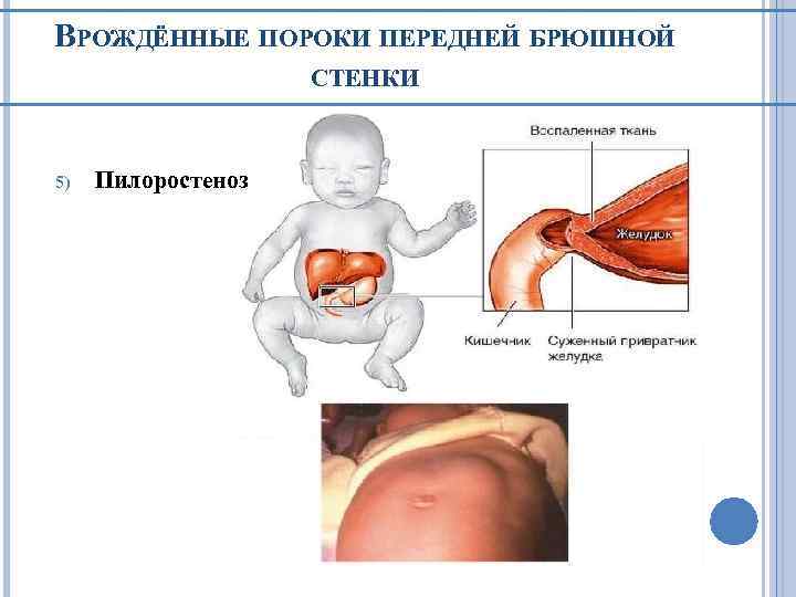 Пилоростеноз у новорожденных операция. Врожденный пилоростеноз. Врожденный дефект передней брюшной стенки.