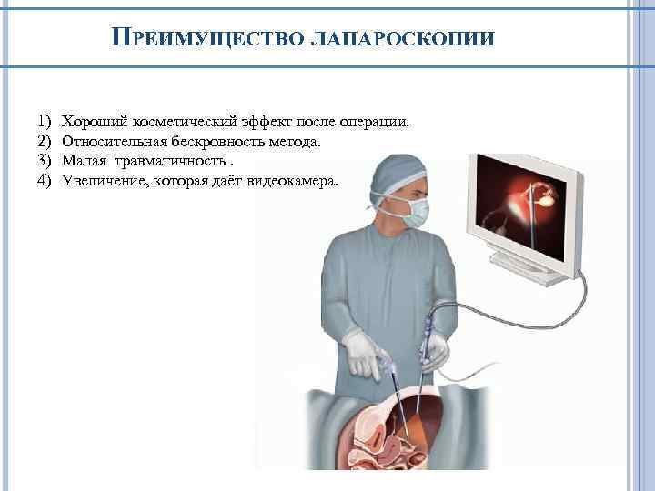 ПРЕИМУЩЕСТВО ЛАПАРОСКОПИИ 1) 2) 3) 4) Хороший косметический эффект после операции. Относительная бескровность метода.