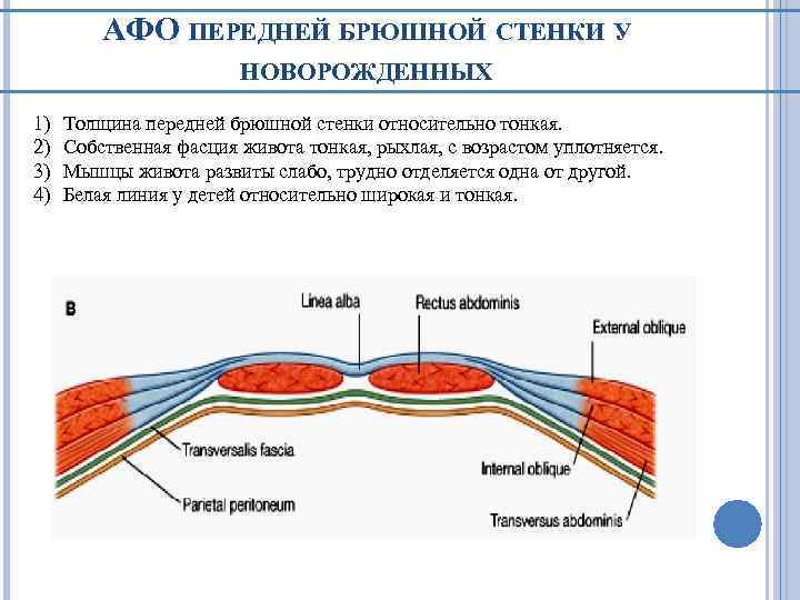 АФО ПЕРЕДНЕЙ БРЮШНОЙ СТЕНКИ У НОВОРОЖДЕННЫХ 1) 2) 3) 4) Толщина передней брюшной стенки