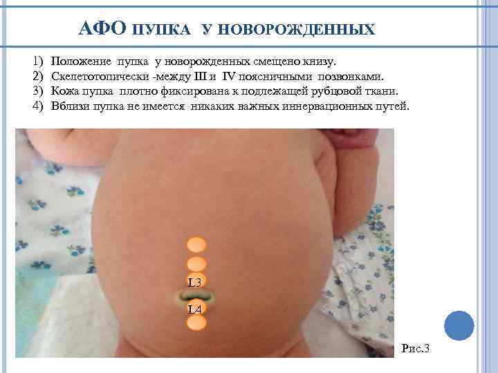 АФО ПУПКА 1) 2) 3) 4) У НОВОРОЖДЕННЫХ Положение пупка у новорожденных смещено книзу.