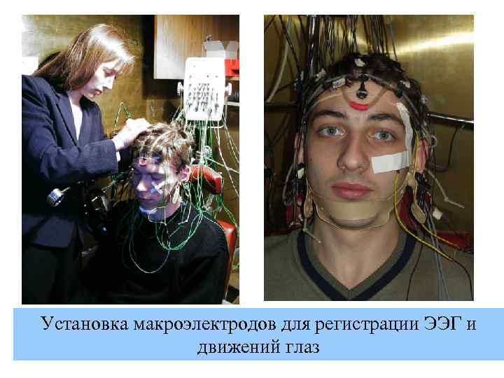 Установка макроэлектродов для регистрации ЭЭГ и движений глаз 