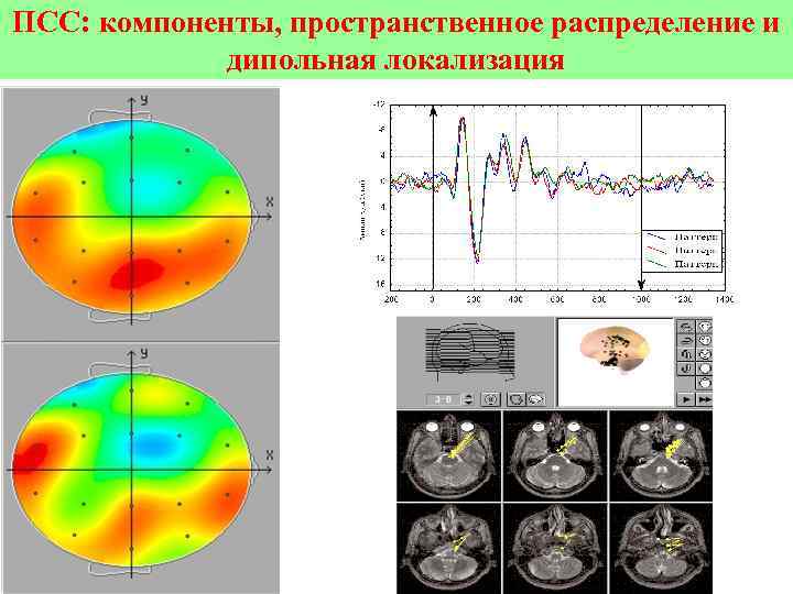ПСС: компоненты, пространственное распределение и дипольная локализация 